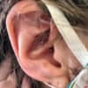 ear piercing for migraine patients