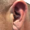 male migraine patients ear piercing