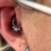 ear piercing for migraine patients