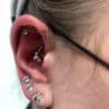 ear piercing for migraine patients