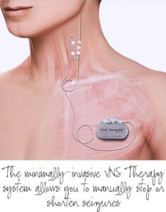 chest hole for migraine solution