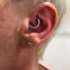 ear piercing for migraine patients