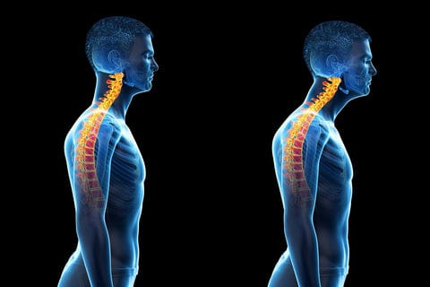 neck posture that cause migraine